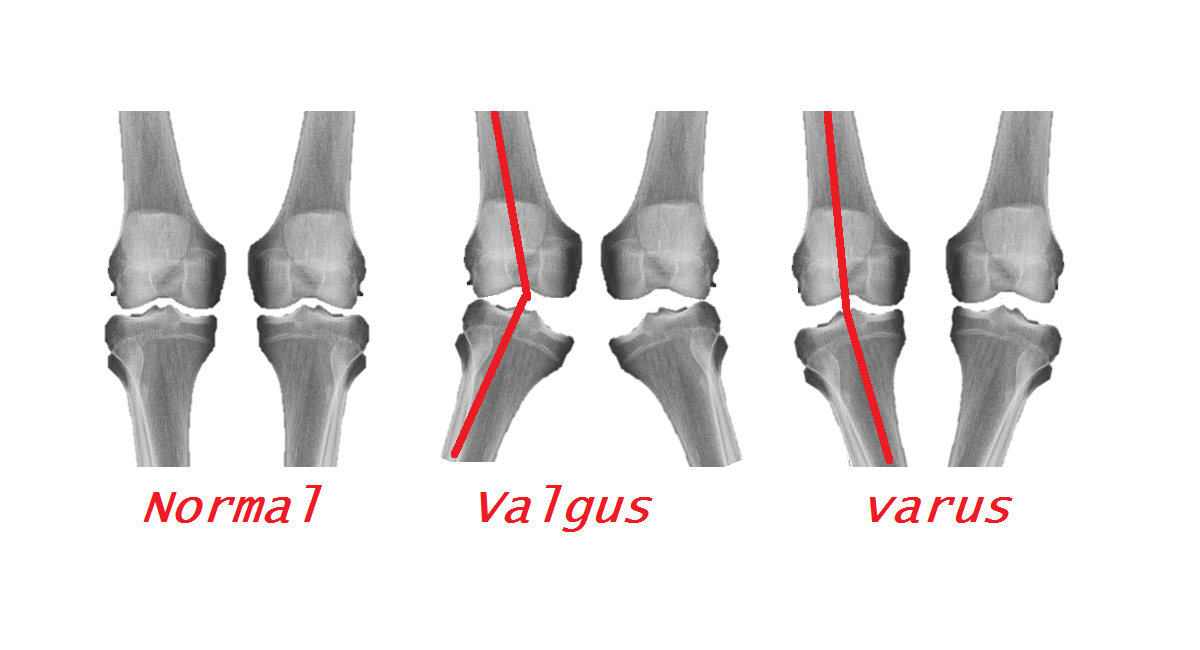Varus and Valgus deformities. What are they and how do they affect me?